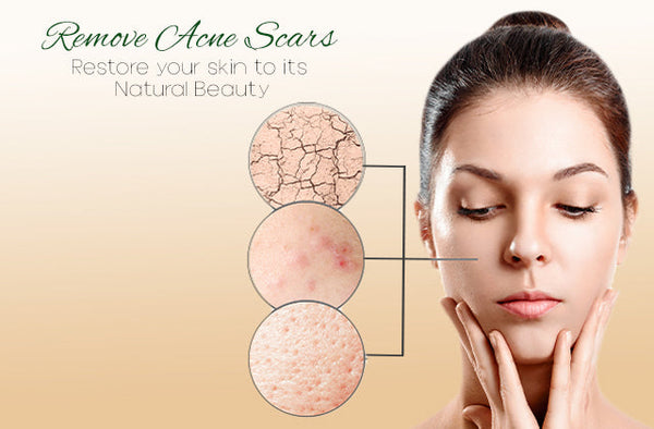 How to Choose the Best Acne Control Kit for Your Skin Type