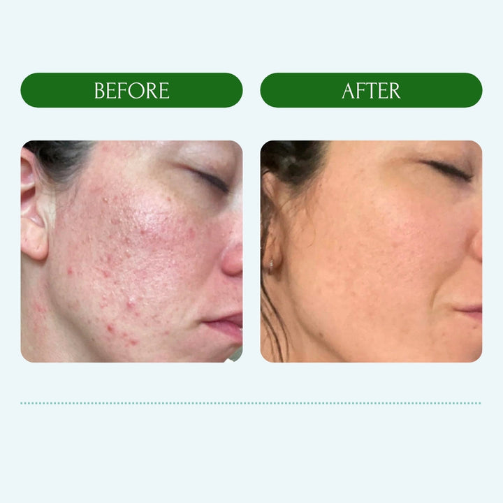 Acne Face Wash - MEABIA