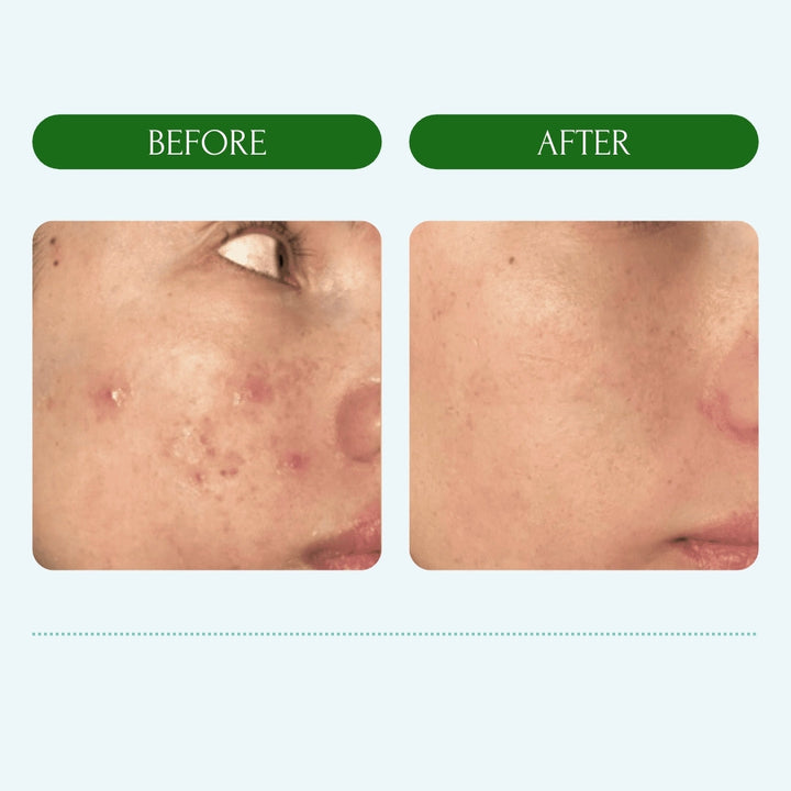 Acne Face Scrub - MEABIA